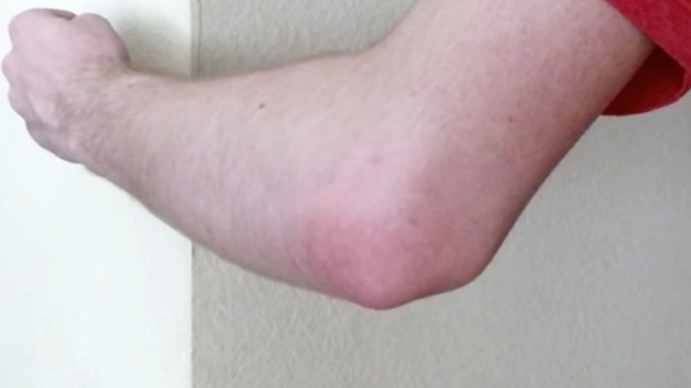 technoblade elbow